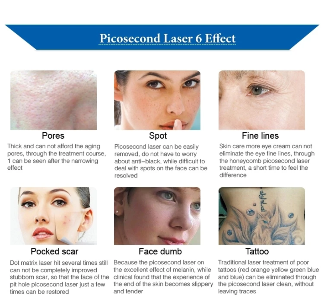 Quantum Picosecond Tattoo Removal Laser ? product detail