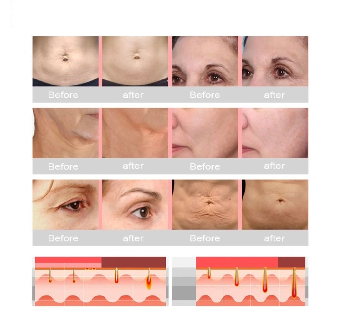 HIFU Treatment Handpiece ? product detail